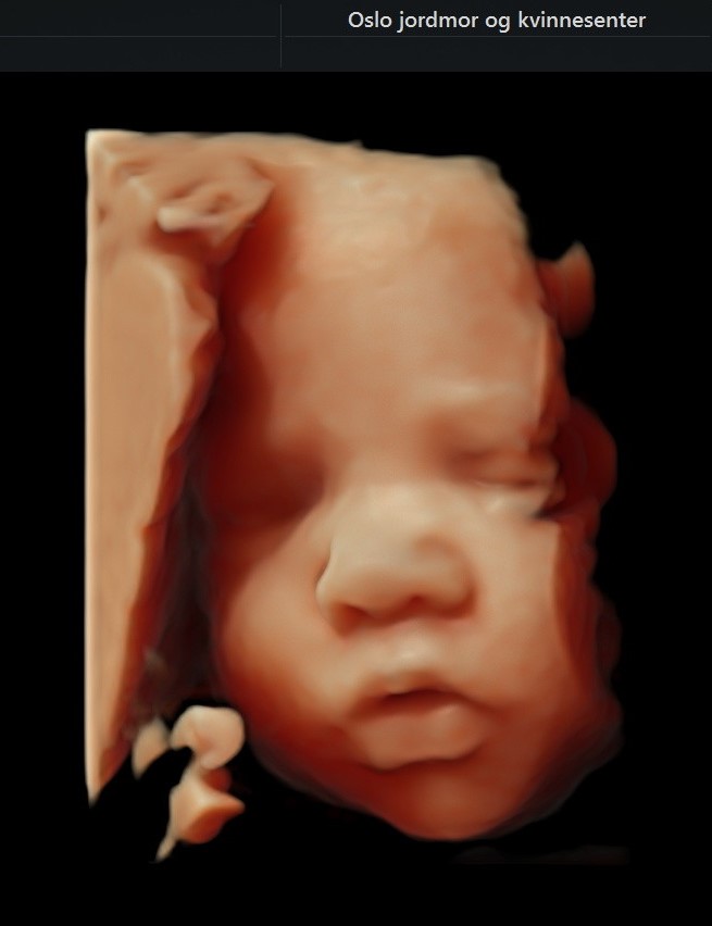 3d ultralyd for gravide
